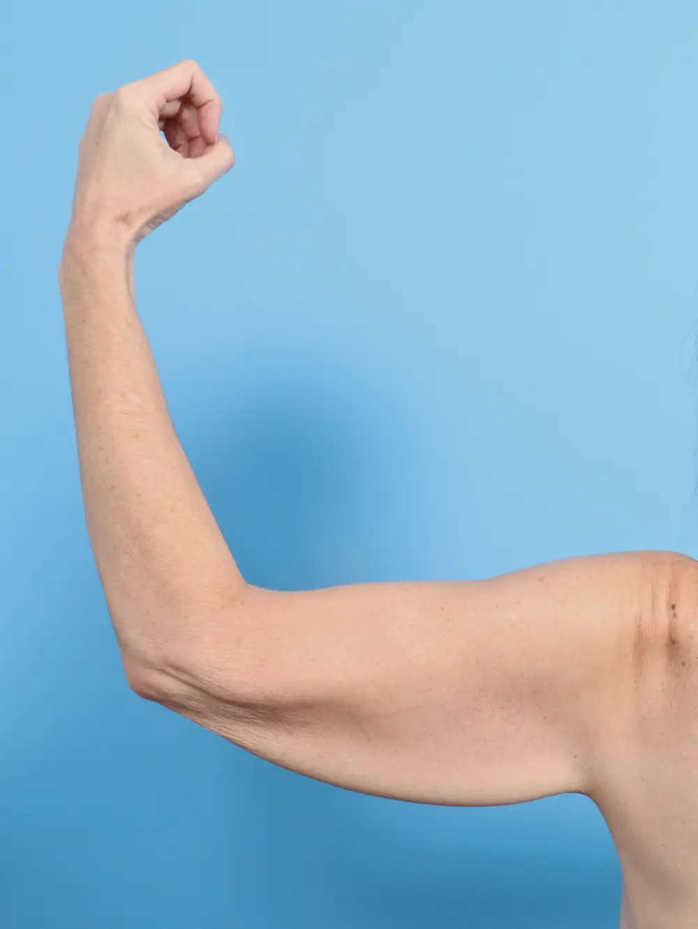 Before Brachioplasty