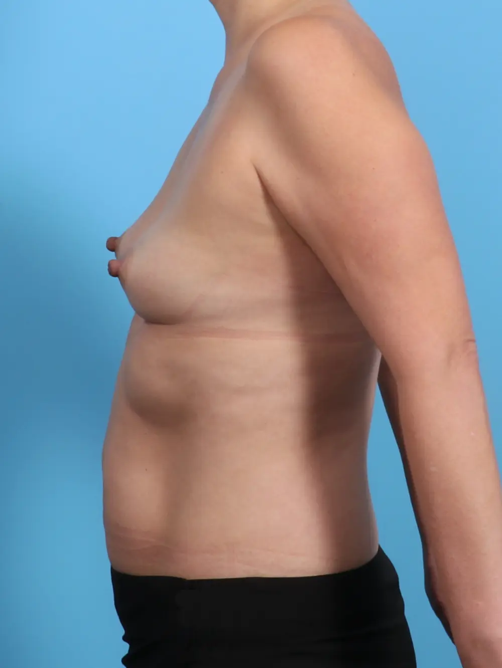 Breast Augmentation Patient Photo - Case 29305 - before view-2