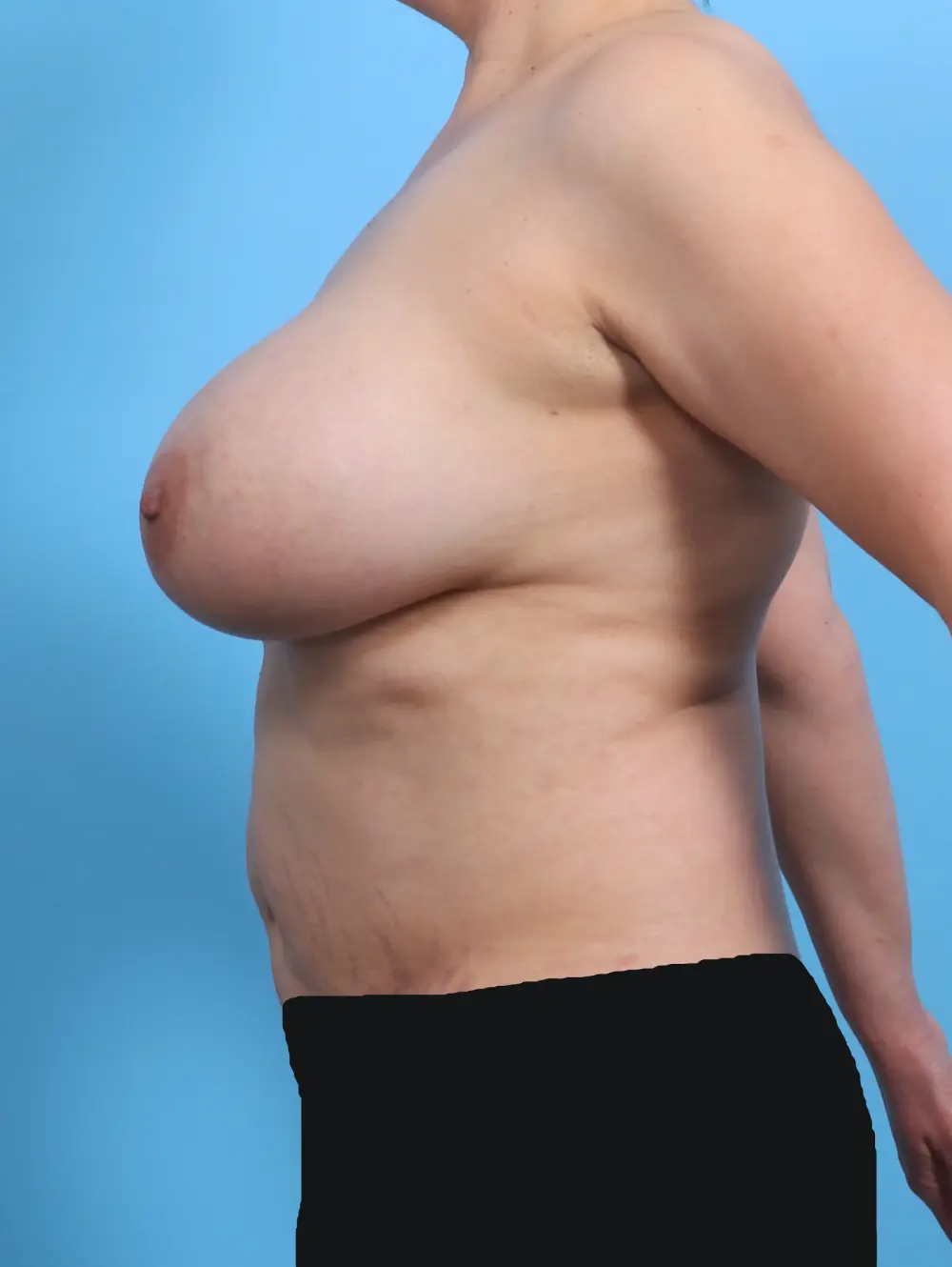 Breast Implant Removal Patient Photo - Case 29313 - before view-2