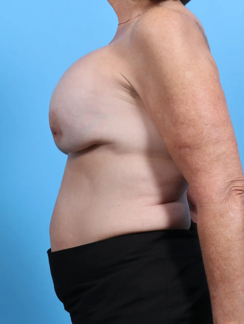 Breast Implant Revision Patient Photo - Case 29321 - before view-2