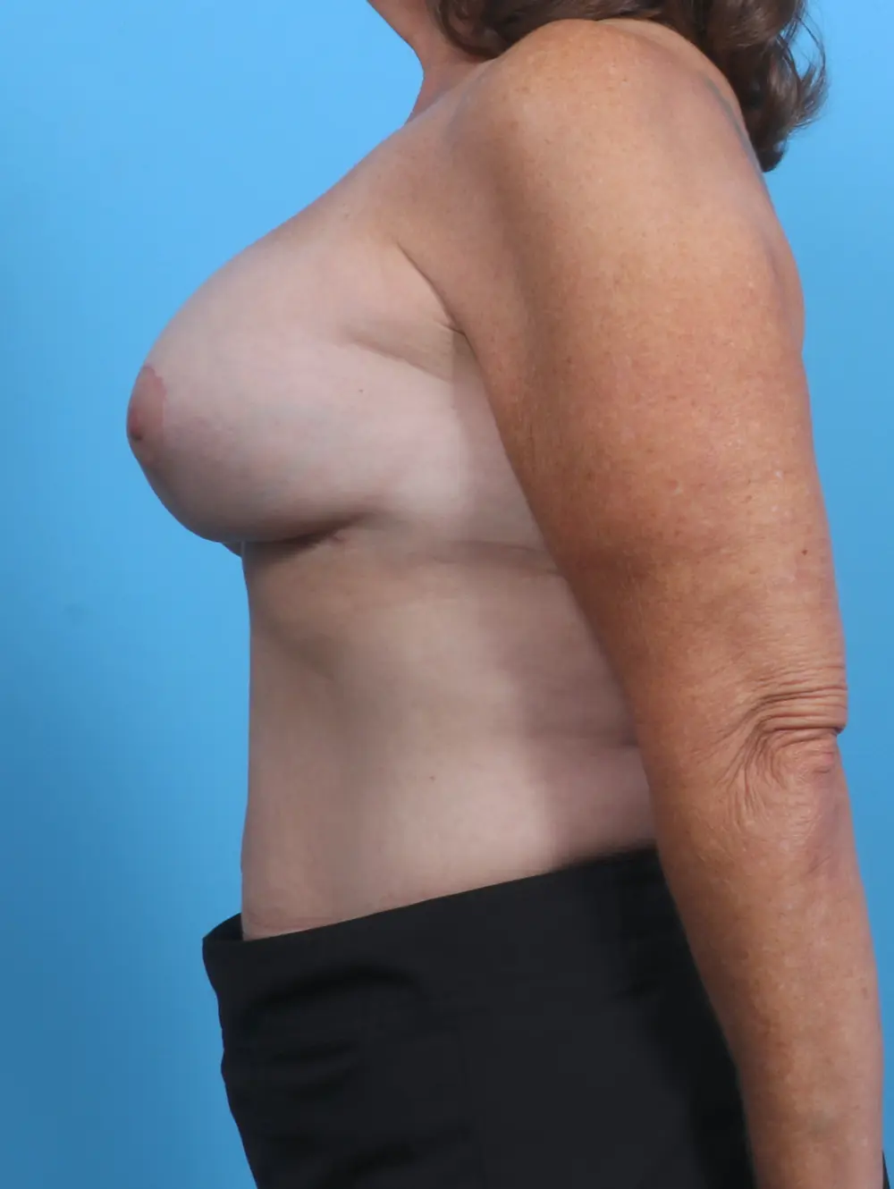 Breast Implant Revision Patient Photo - Case 29321 - after view-2