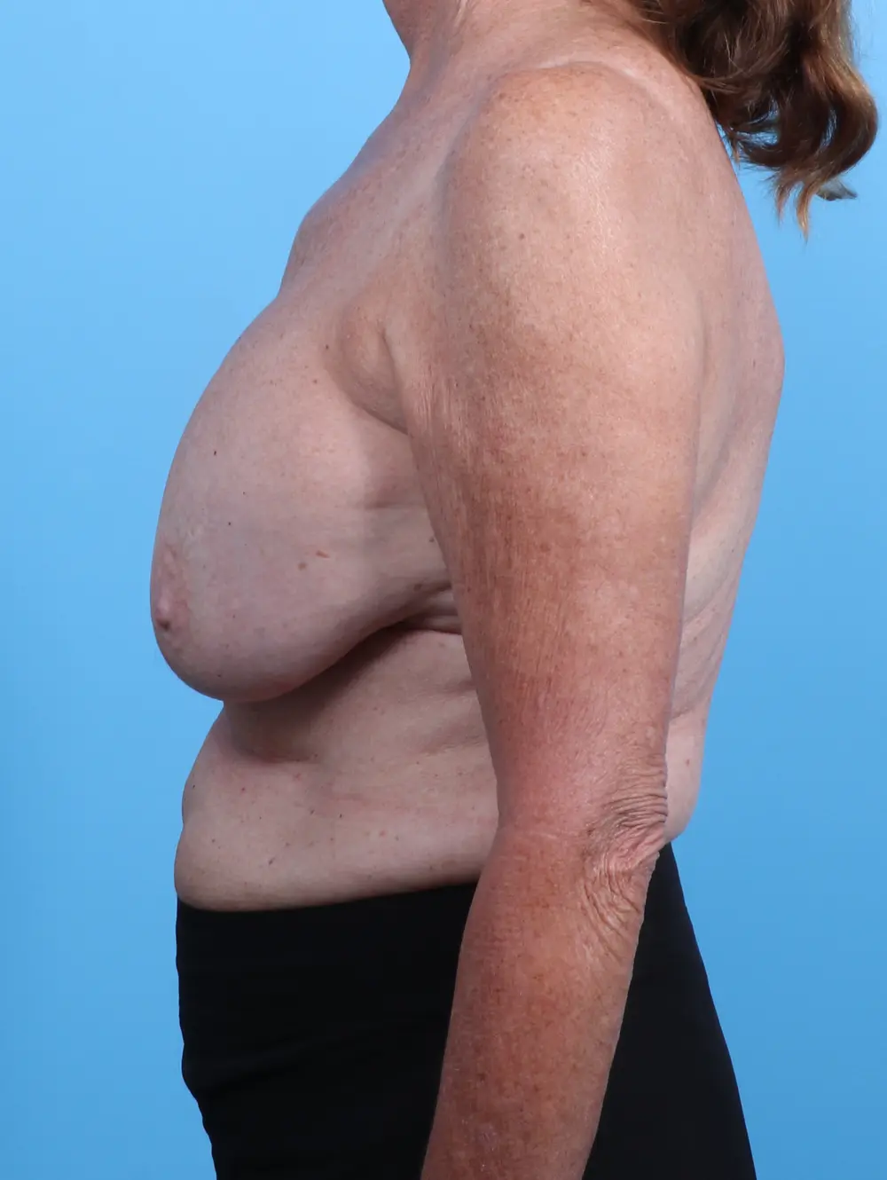 Breast Implant Revision Patient Photo - Case 29343 - before view-2