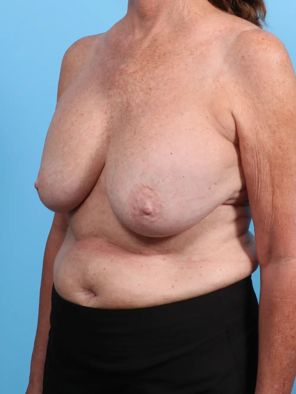 Breast Implant Revision Patient Photo - Case 29343 - before view-1