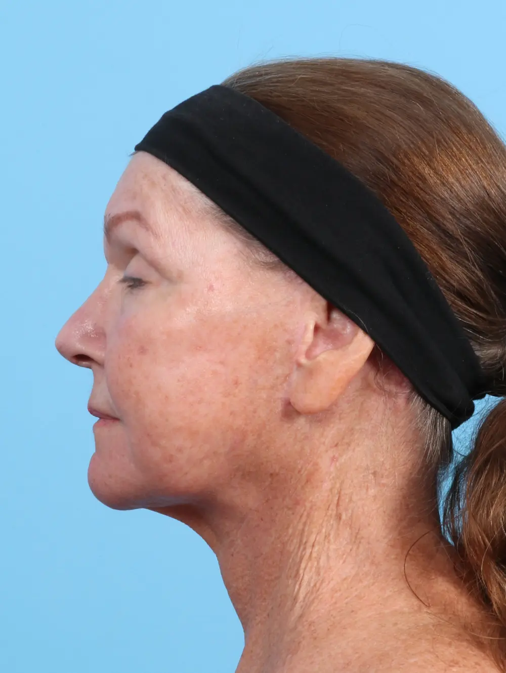 Eyelid Surgery Patient Photo - Case 29329 - before view-2