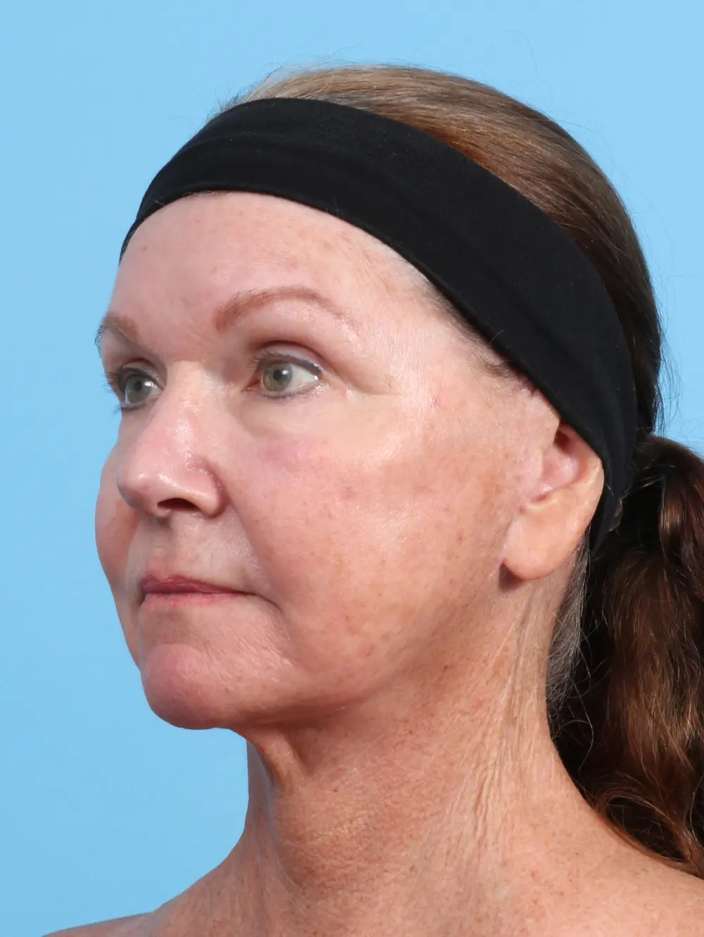 Eyelid Surgery Patient Photo - Case 29329 - before view-1