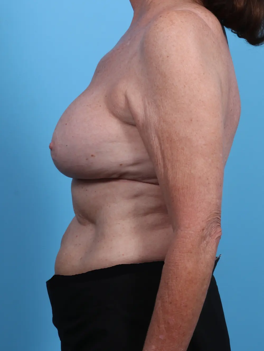 Breast Implant Revision Patient Photo - Case 29343 - after view-2