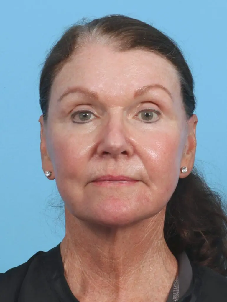 Eyelid Surgery - Case 29329 - After