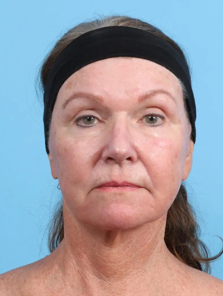 Eyelid Surgery - Case 29329 - Before