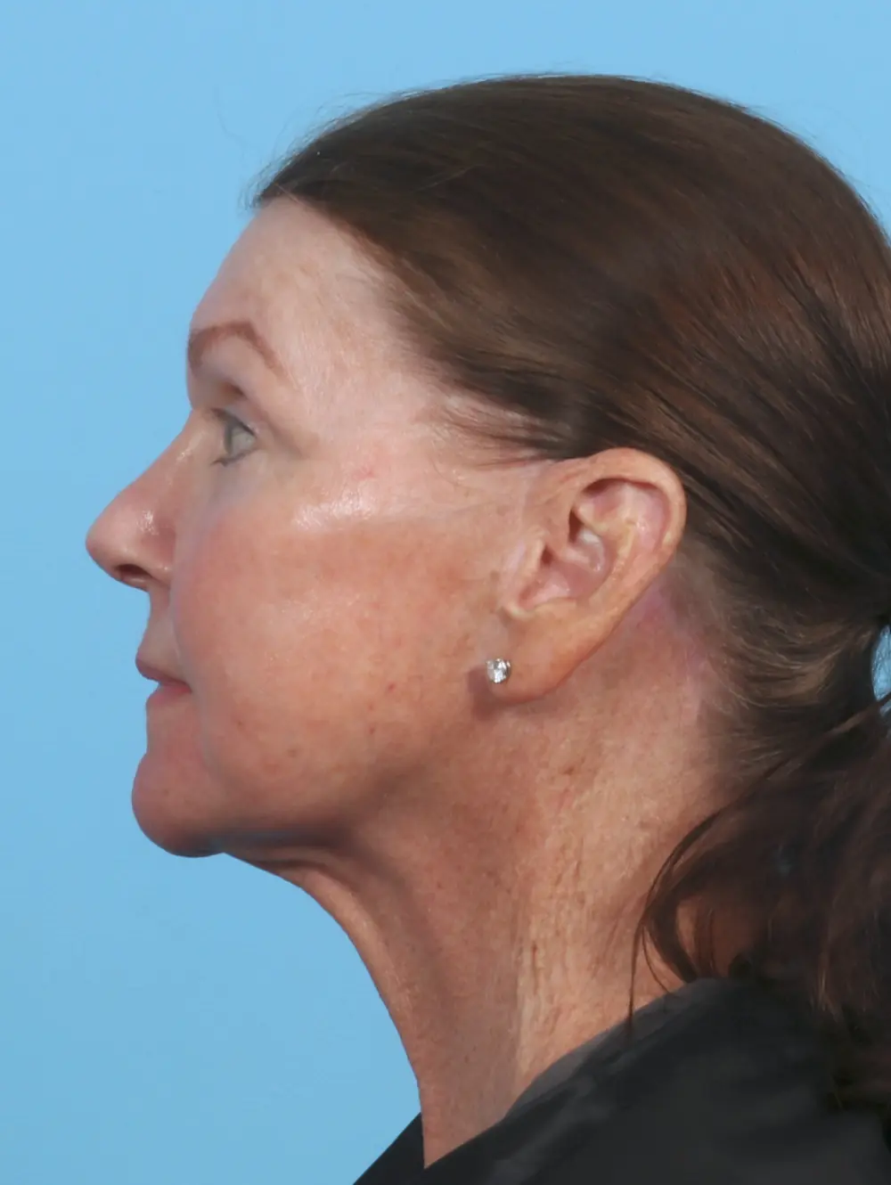 Eyelid Surgery Patient Photo - Case 29329 - after view-2