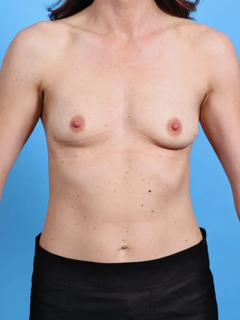 Breast Augmentation - Case 29345 - Before