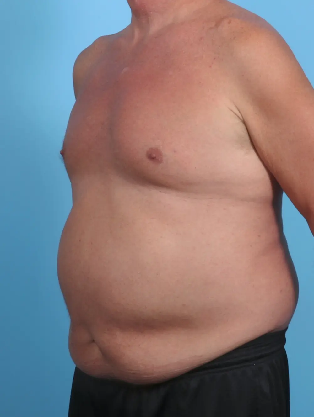 Male Tummy Tuck Patient Photo - Case 29361 - before view-1