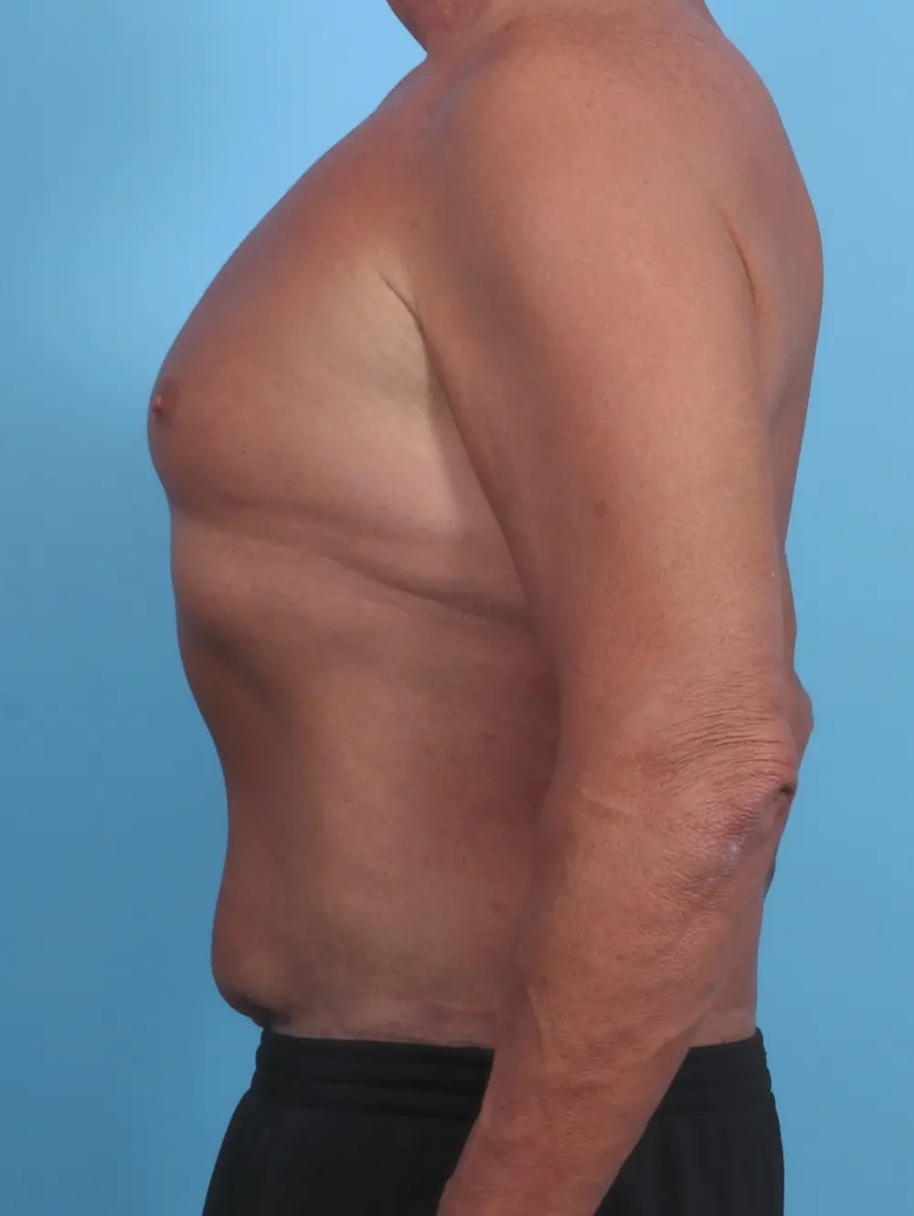 Male Tummy Tuck Patient Photo - Case 29361 - after view-2