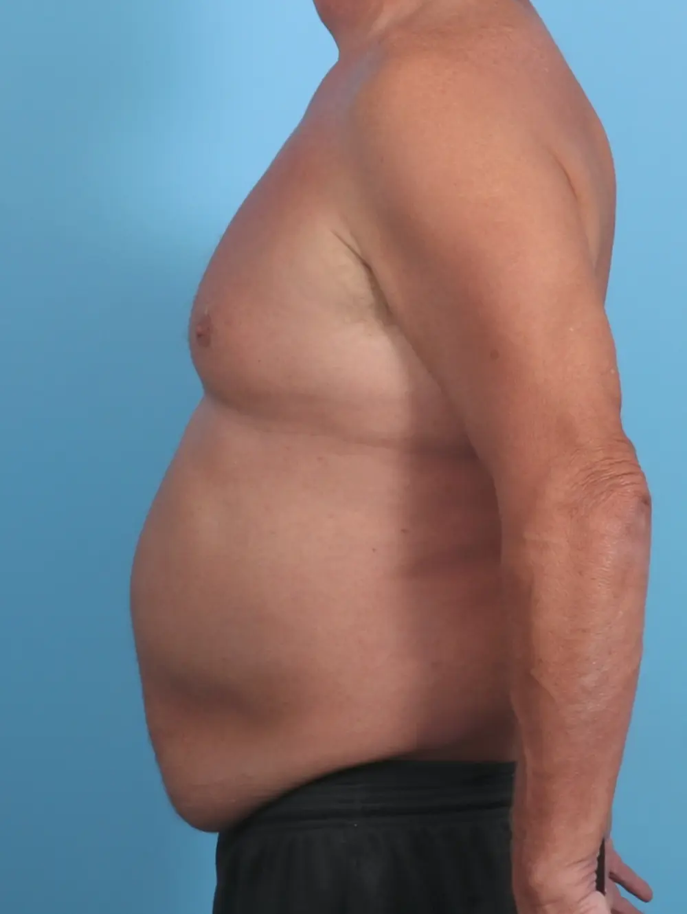 Male Tummy Tuck Patient Photo - Case 29361 - before view-2