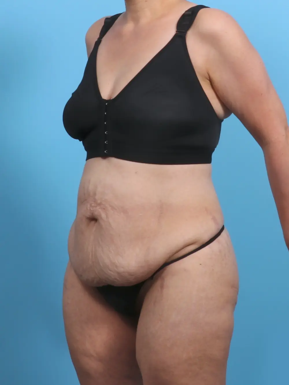 Tummy Tuck Patient Photo - Case 29369 - before view-1