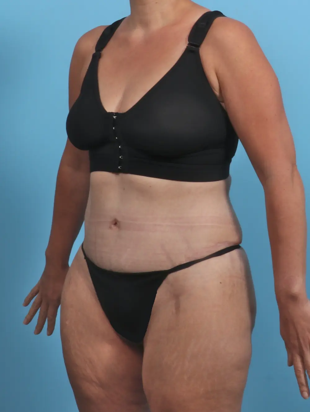 Tummy Tuck Patient Photo - Case 29369 - after view-1