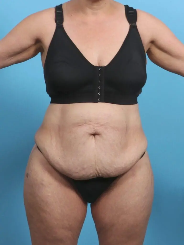 Tummy Tuck - Case 29369 - Before