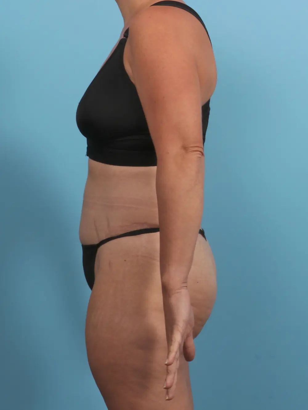 Tummy Tuck Patient Photo - Case 29369 - after view-2