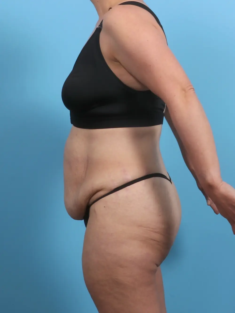 Tummy Tuck Patient Photo - Case 29369 - before view-2