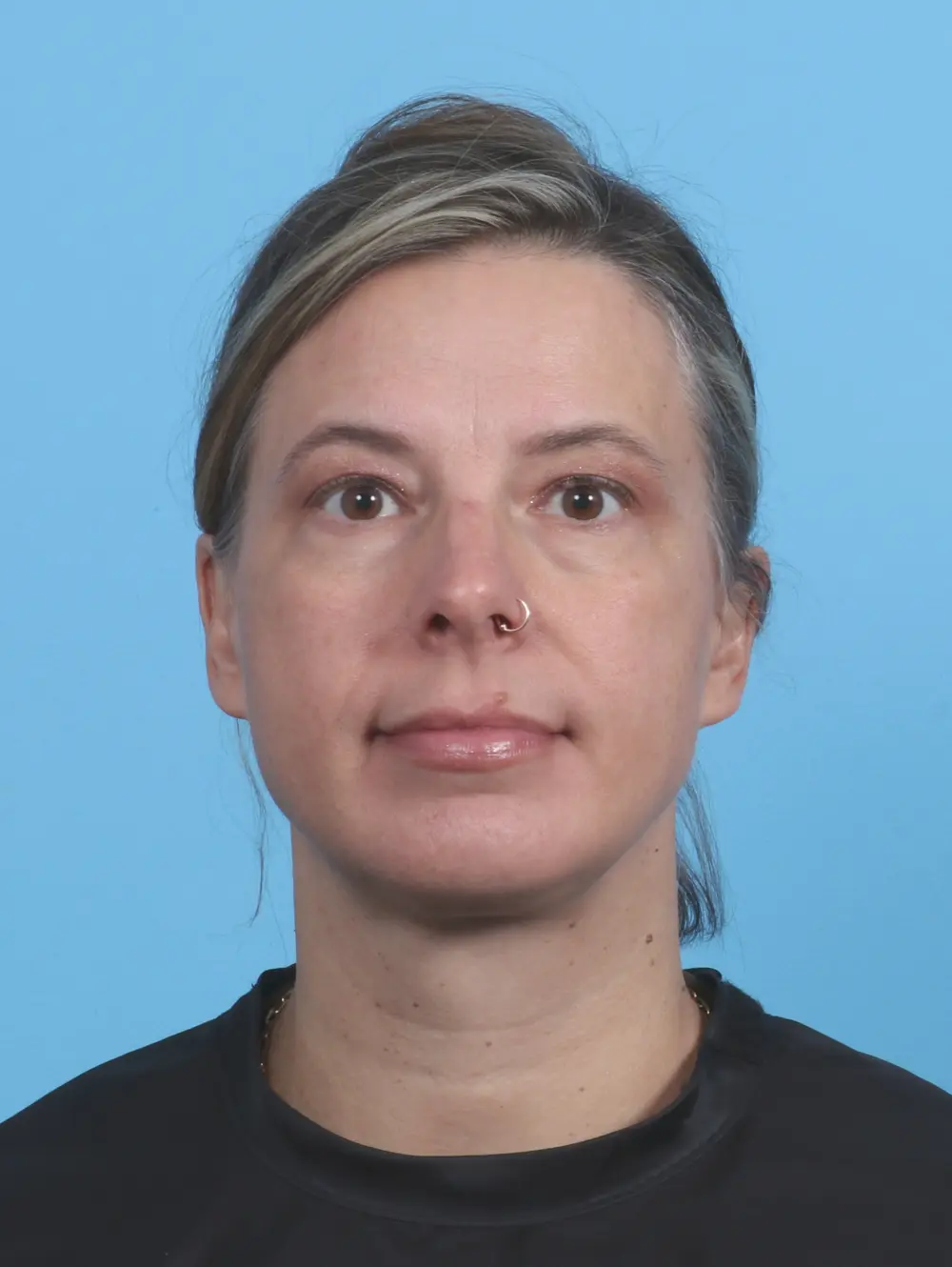 Anterior Neck Lift Patient Photo - Case 29377 - after view-2