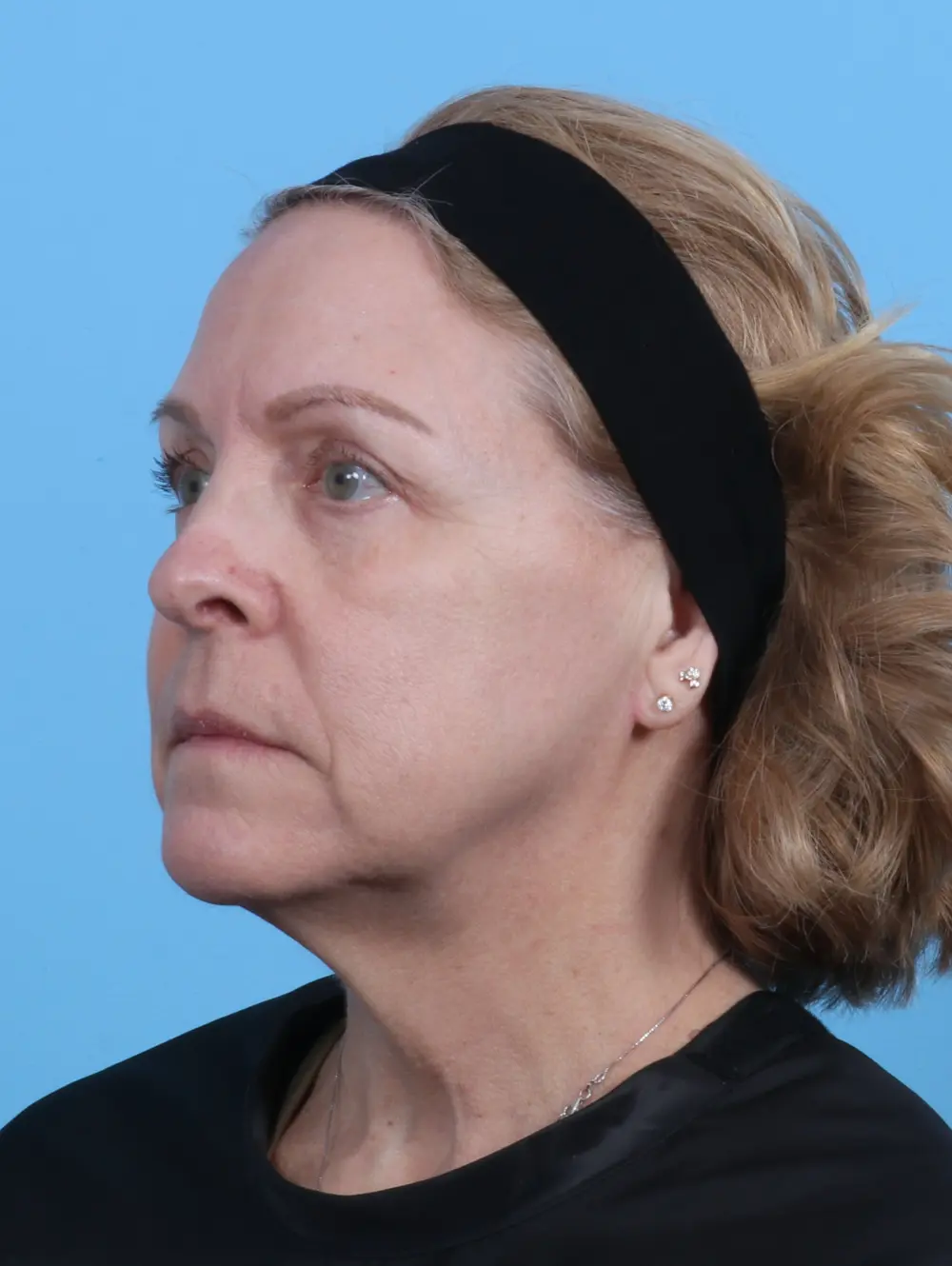 Eyelid Surgery Patient Photo - Case 29393 - after view-1