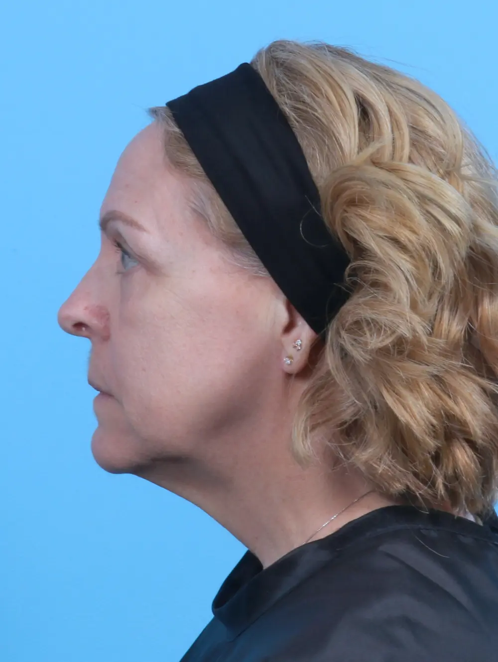 Eyelid Surgery Patient Photo - Case 29393 - after view-2