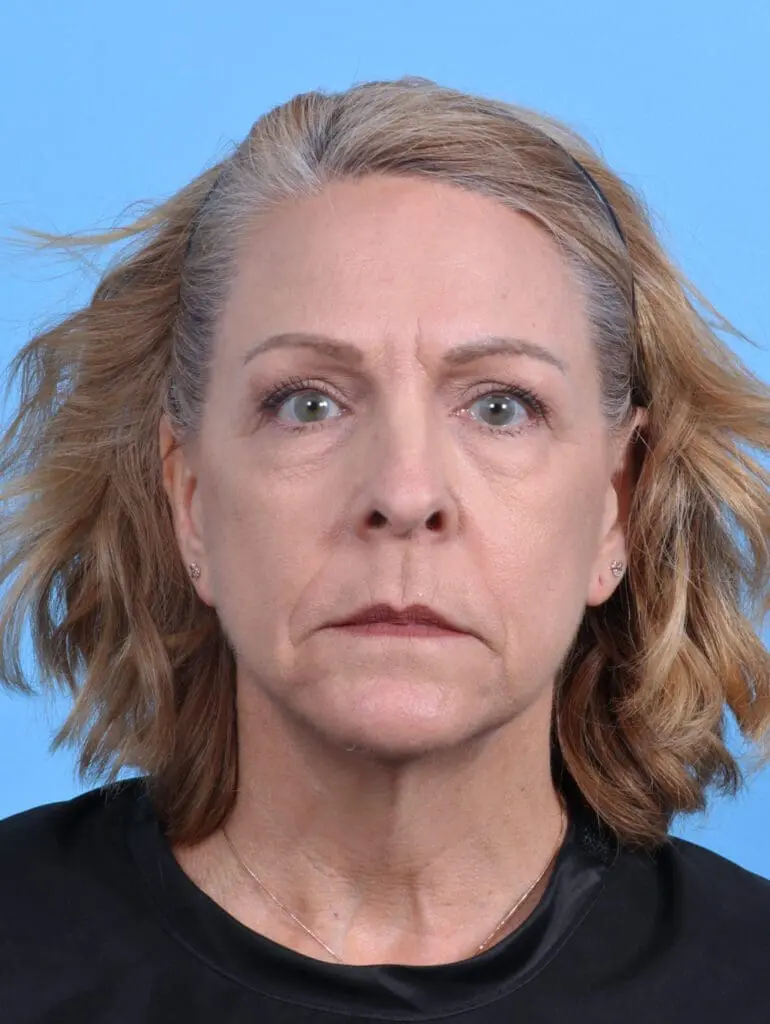 Eyelid Surgery - Case 29393 - Before