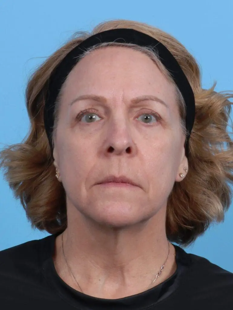 Eyelid Surgery - Case 29393 - After