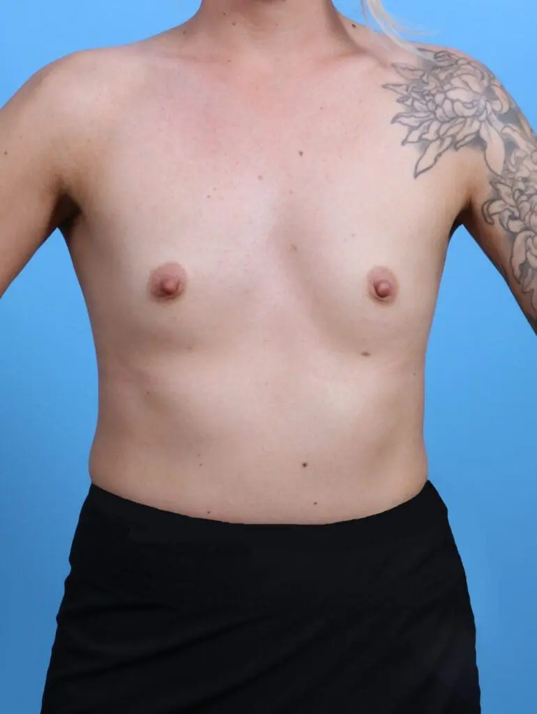 Breast Augmentation - Case 29401 - Before
