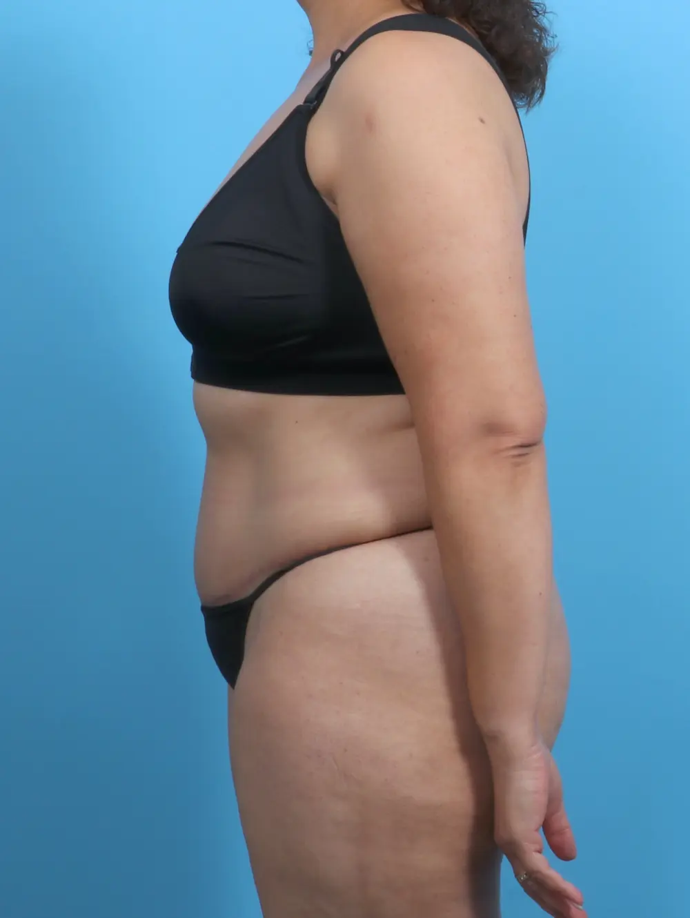 Tummy Tuck Patient Photo - Case 29409 - after view-2