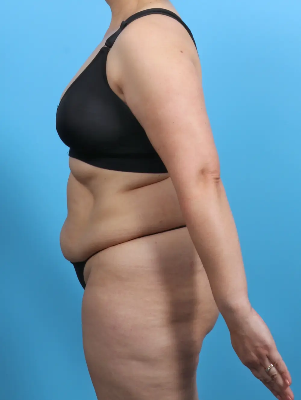 Tummy Tuck Patient Photo - Case 29409 - before view-2