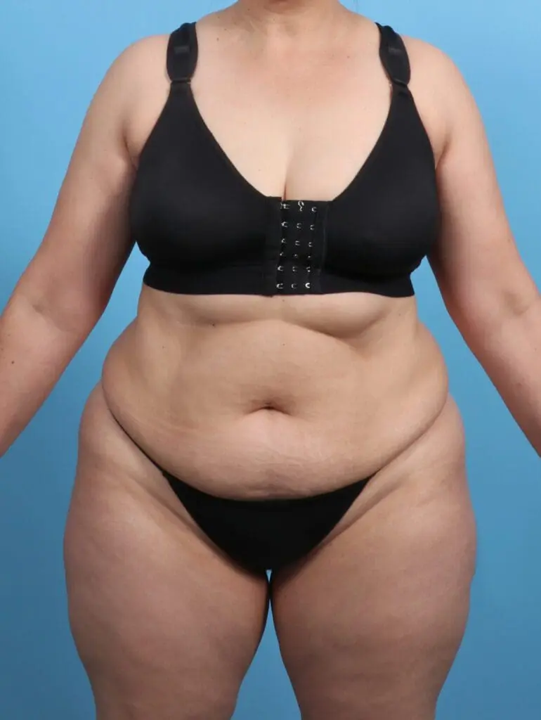 Tummy Tuck - Case 29409 - Before