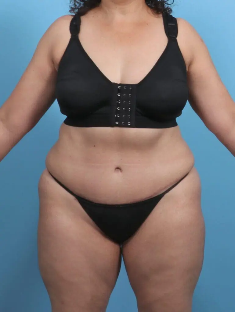 Tummy Tuck - Case 29409 - After