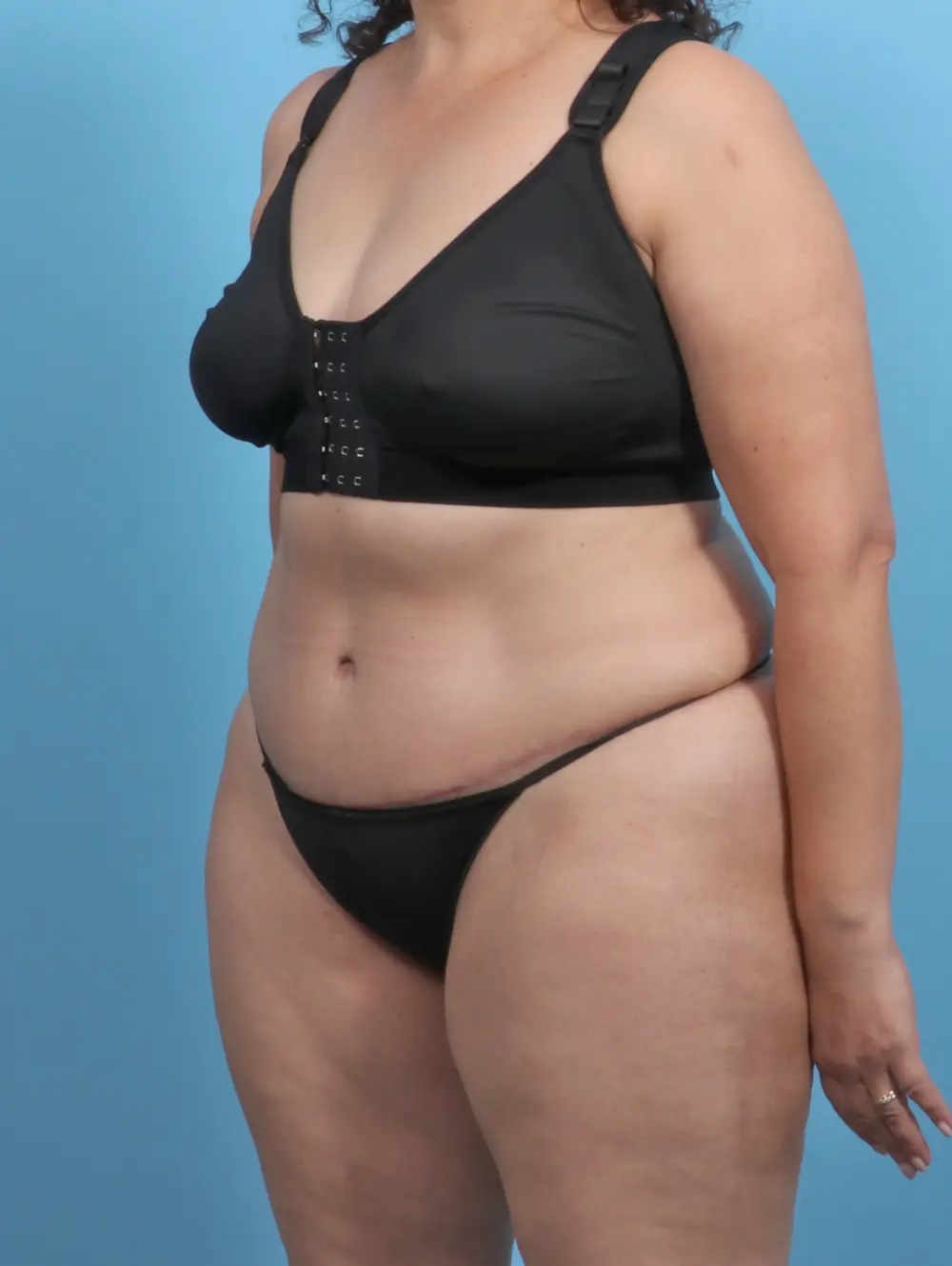 Tummy Tuck Patient Photo - Case 29409 - after view-1