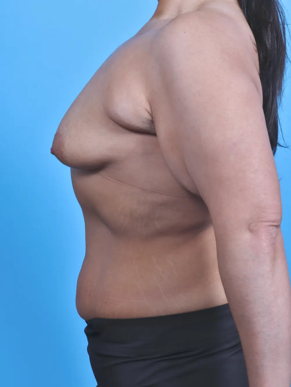 Breast Augmentation Patient Photo - Case 29431 - before view-2