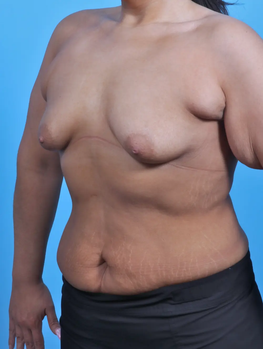 Breast Augmentation Patient Photo - Case 29431 - before view-1