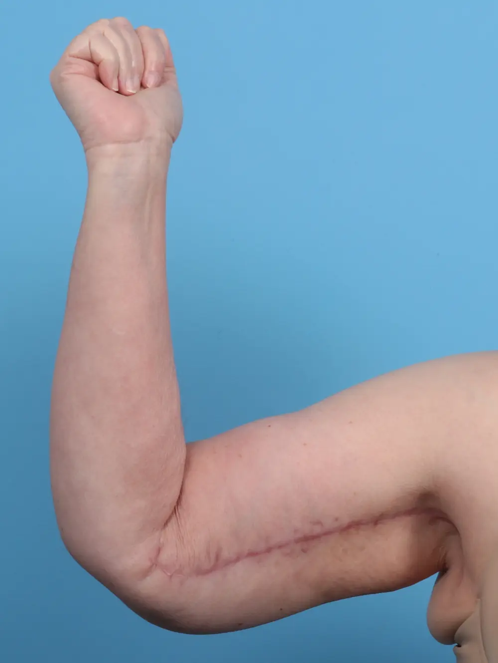 Arm Lift Patient Photo - Case 29440 - after view-1