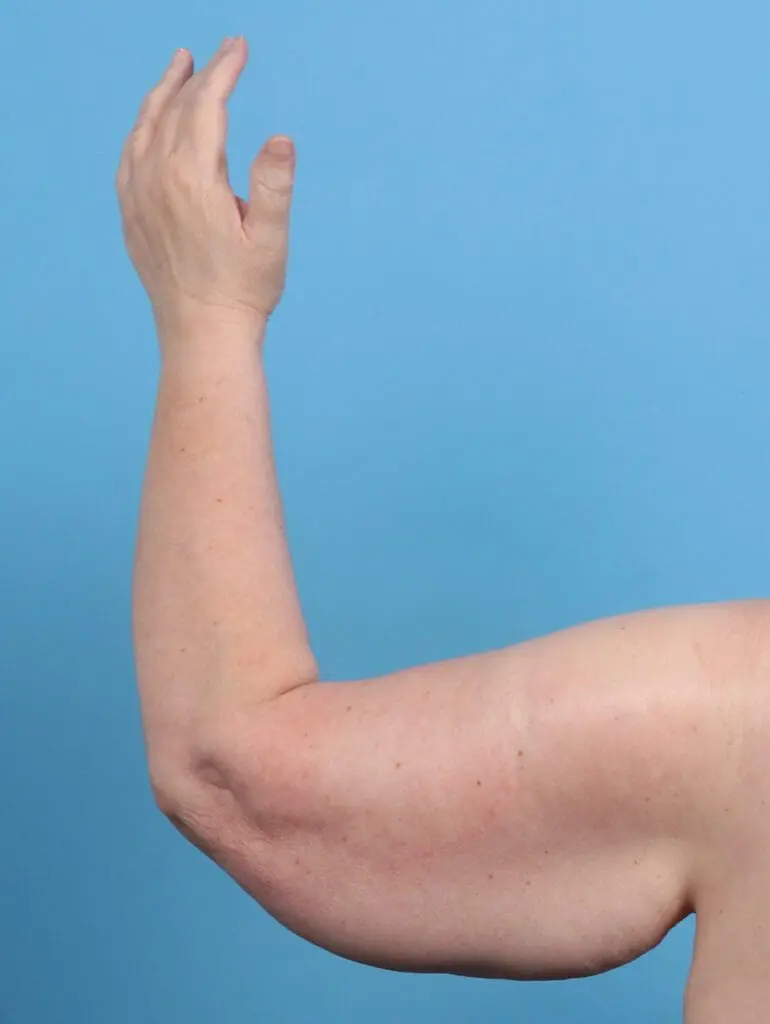 Arm Lift - Case 29440 - Before