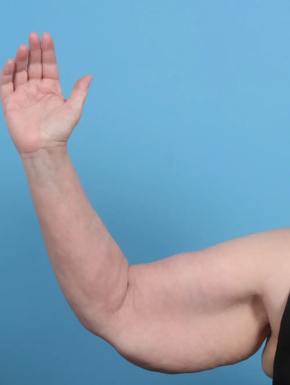 Arm Lift Patient Photo - Case 29440 - before view-1