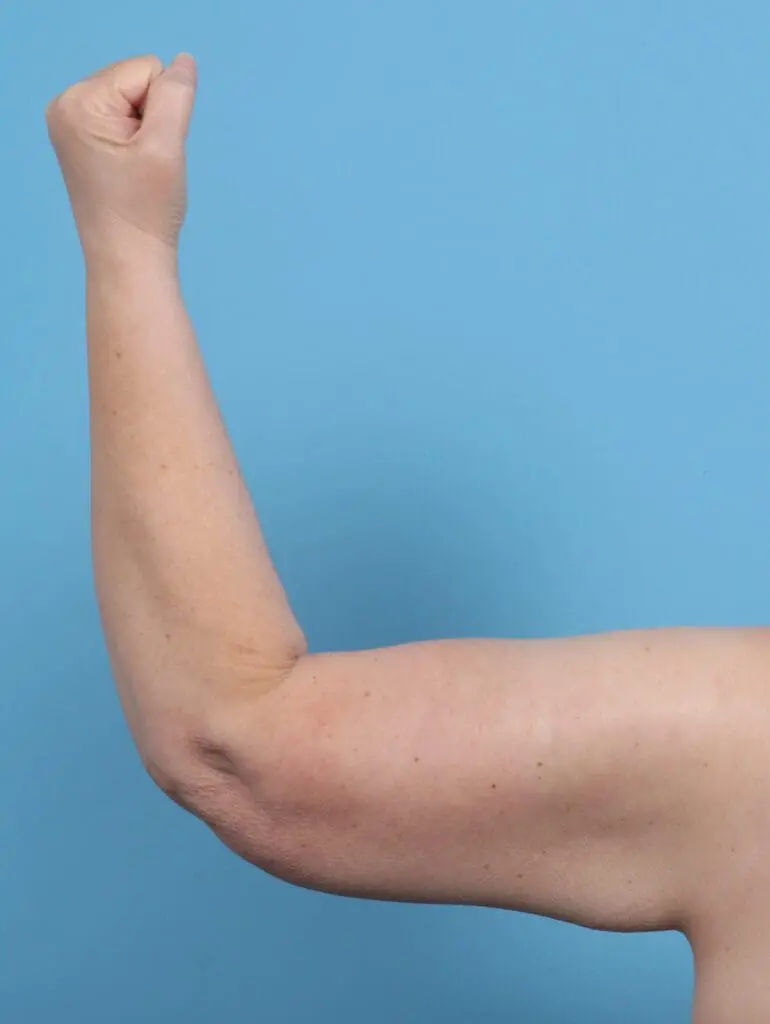 Arm Lift - Case 29440 - After