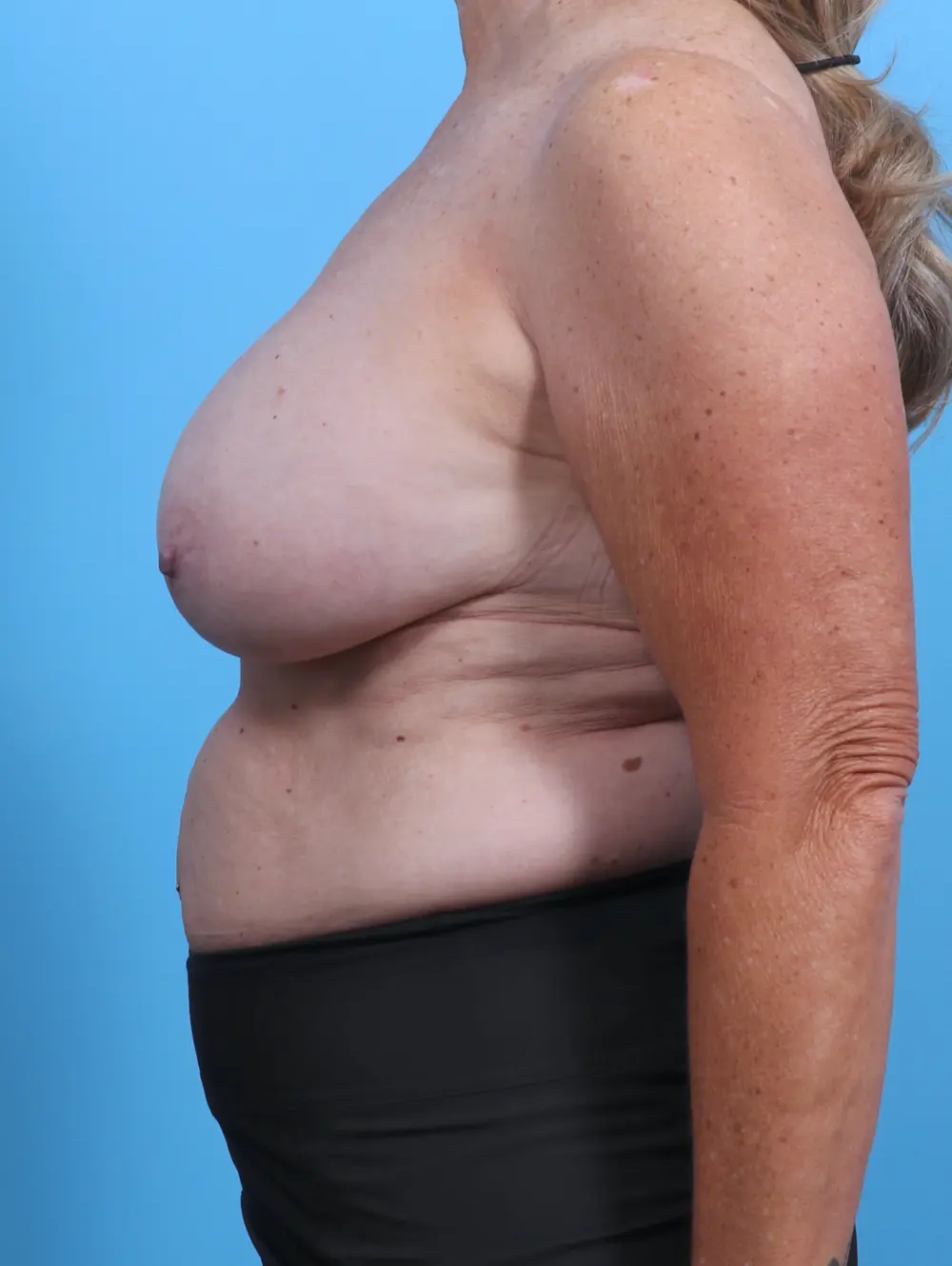 Breast Implant Revision Patient Photo - Case 29446 - before view-2