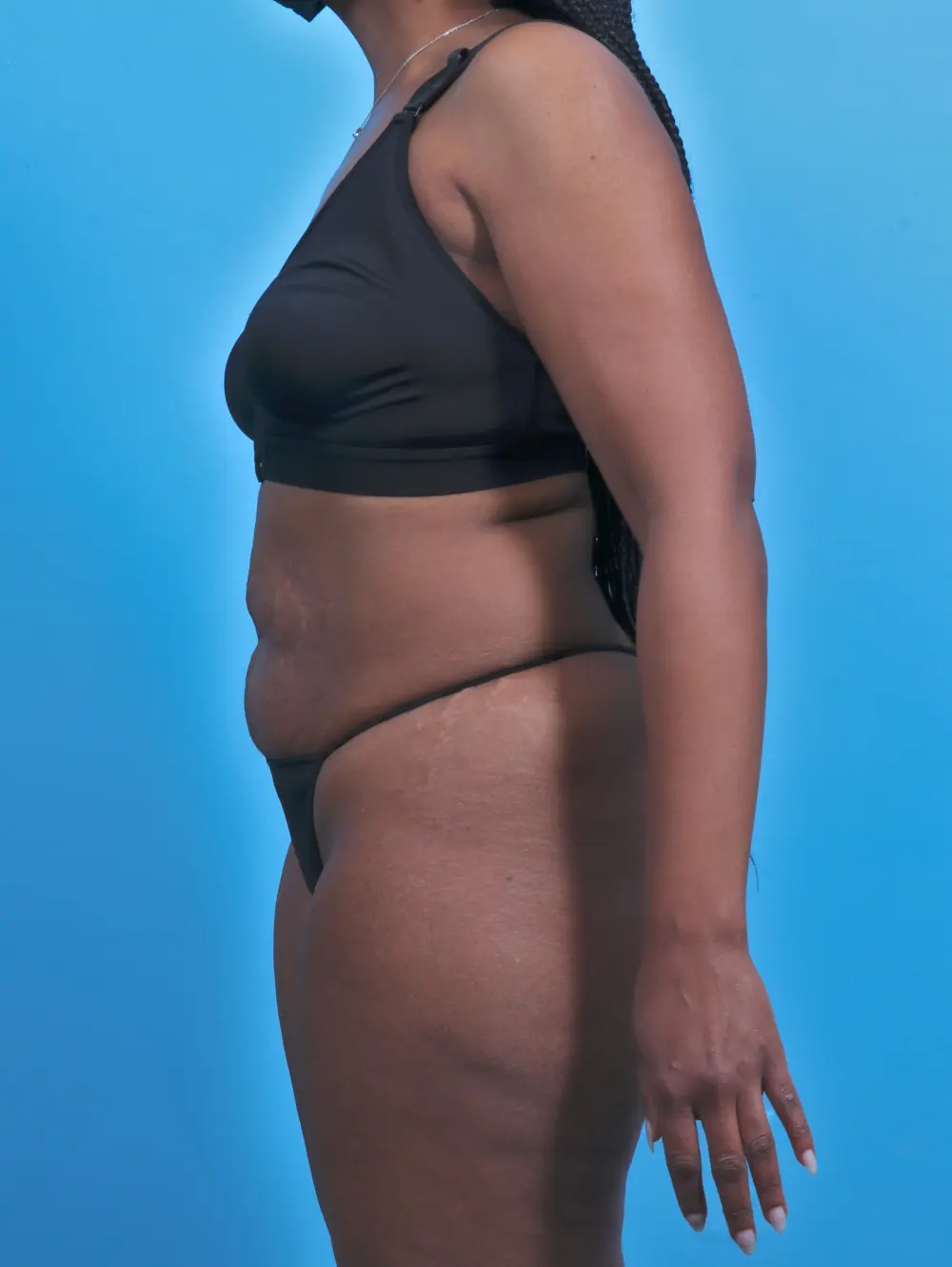 Tummy Tuck Patient Photo - Case 29454 - before view-2