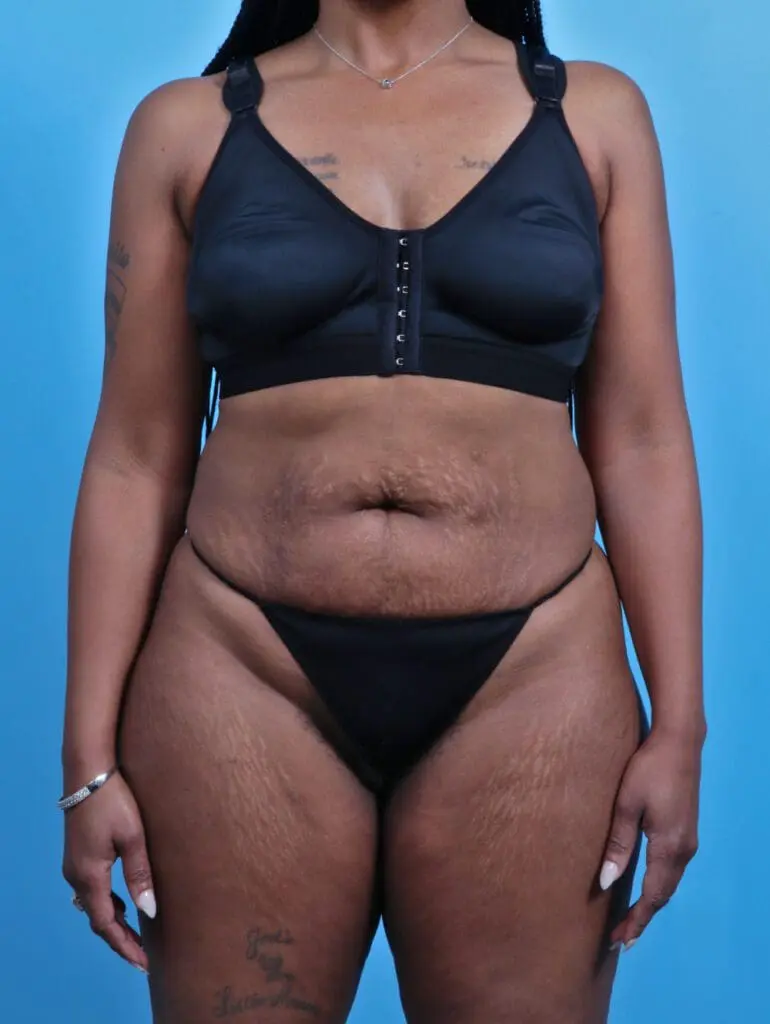 Tummy Tuck - Case 29454 - Before