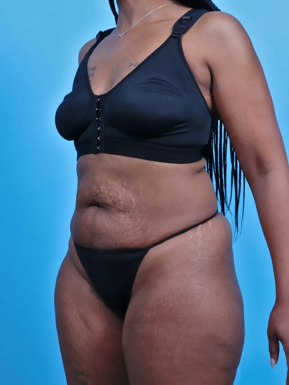 Tummy Tuck Patient Photo - Case 29454 - before view-1