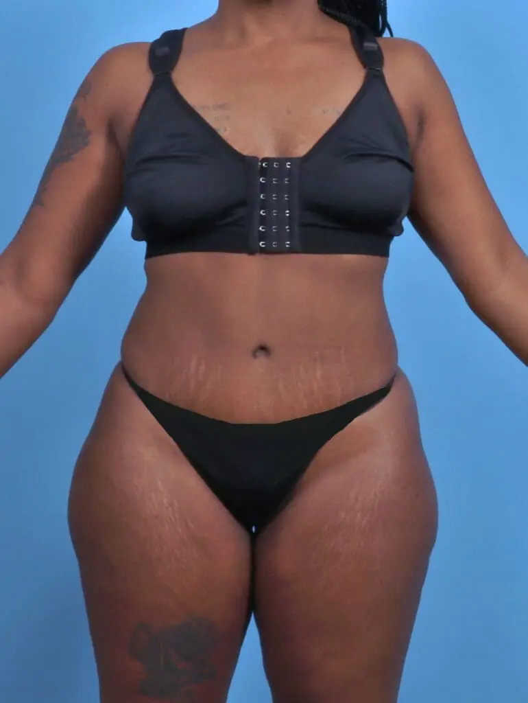 Tummy Tuck - Case 29454 - After