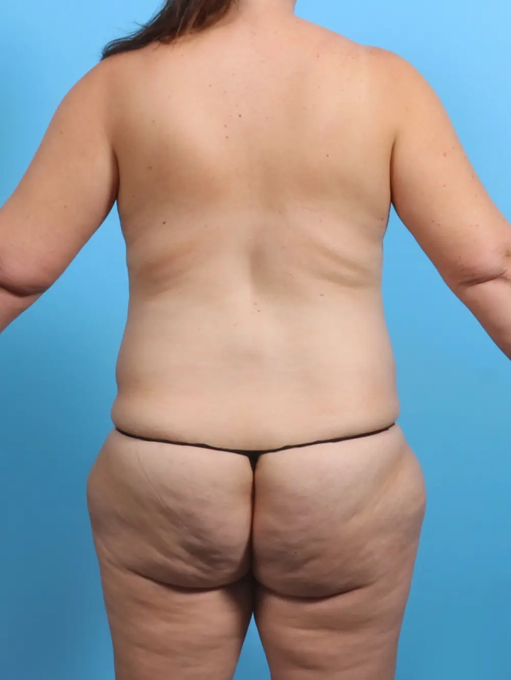 Tummy Tuck Patient Photo - Case 29464 - before view-3