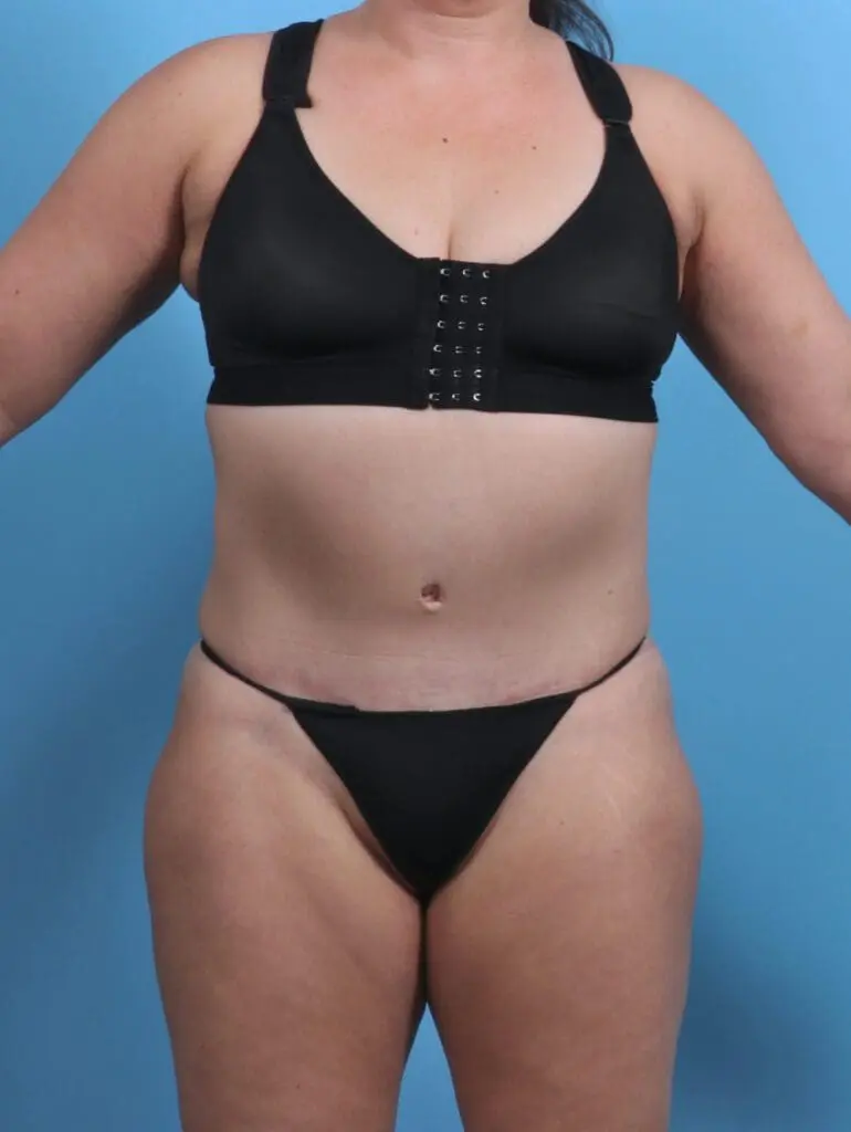 Tummy Tuck - Case 29464 - After