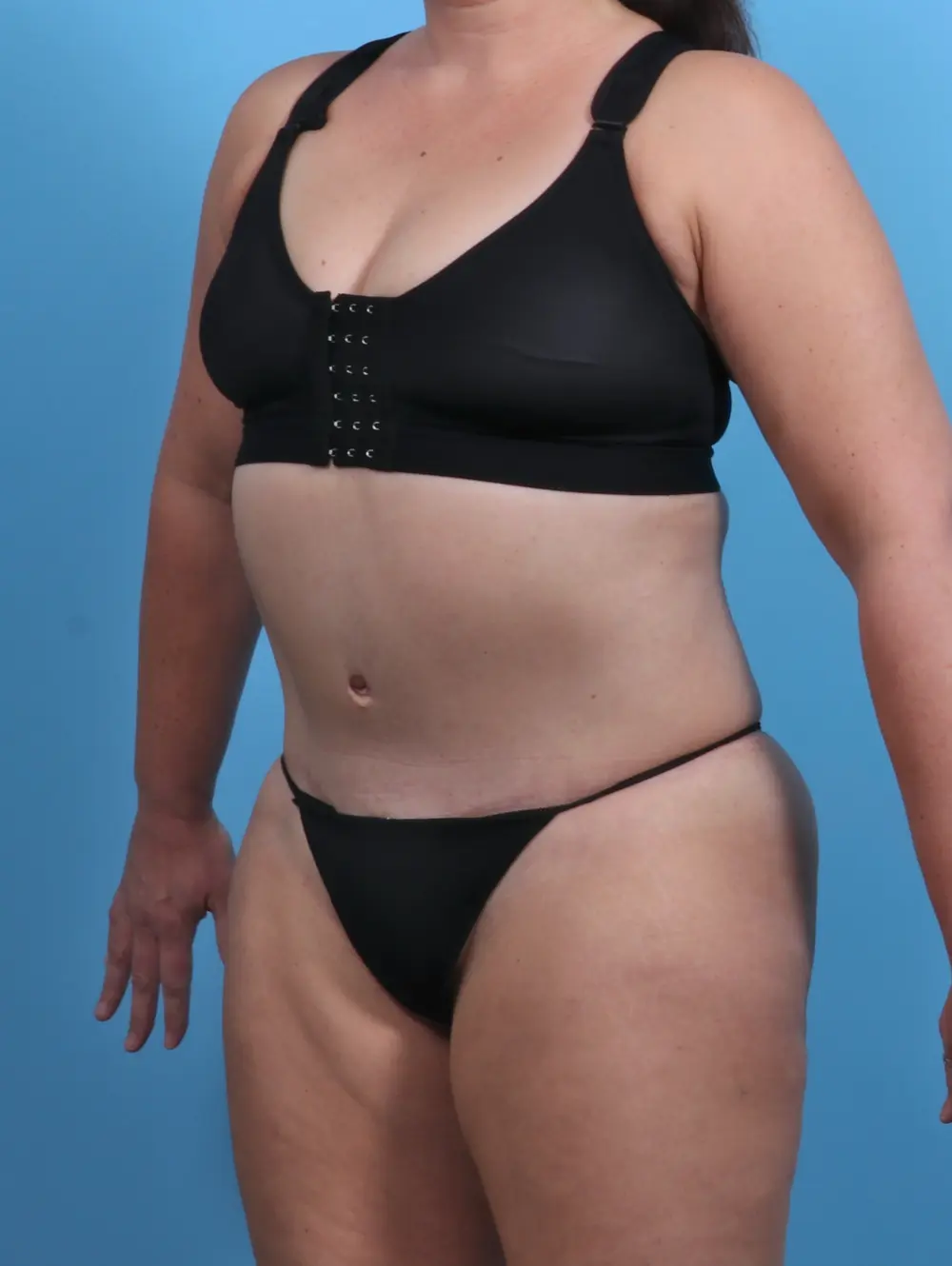 Tummy Tuck Patient Photo - Case 29464 - after view-1