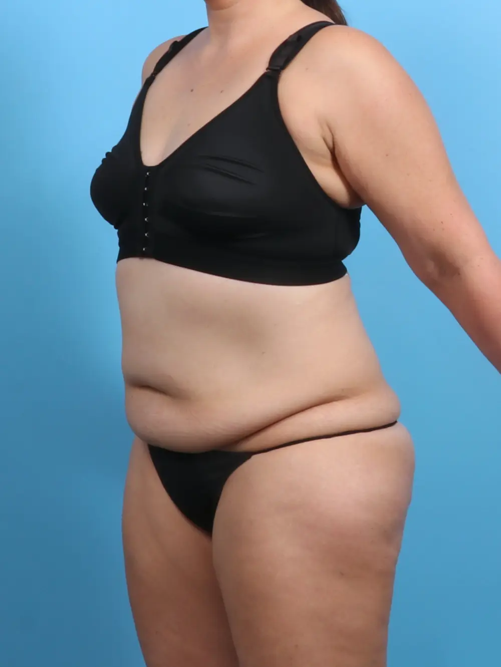 Tummy Tuck Patient Photo - Case 29464 - before view-1
