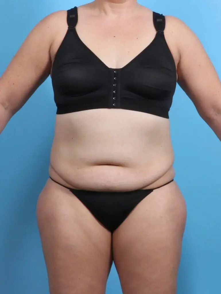 Tummy Tuck - Case 29464 - Before