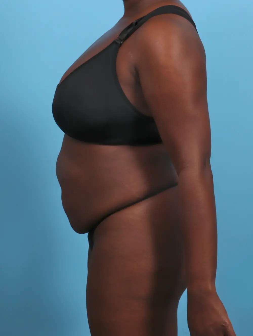 Tummy Tuck Patient Photo - Case 29474 - before view-2